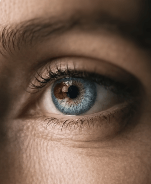 Closeup of an eye representing features associated with uveal melanoma